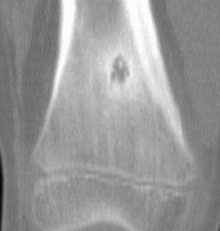 Osteoma osteoide