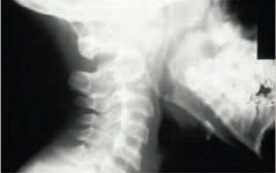 Displasia spondiloepifisaria congenita