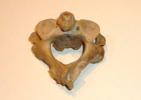 Displasia spondiloepifisaria congenita
