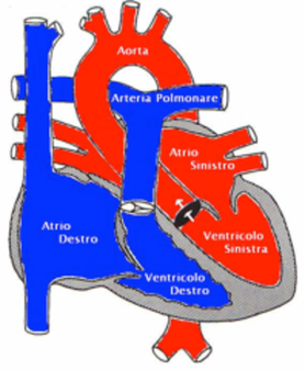 Stenosi valvolare aortica