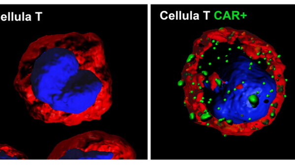 Terapia genica: cellule "riprogrammate" contro il tumore. Primo paziente trattato al Bambino Gesù