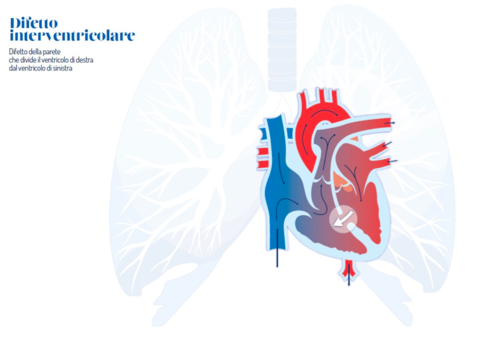 Sindrome di Down e cardiopatie congenite