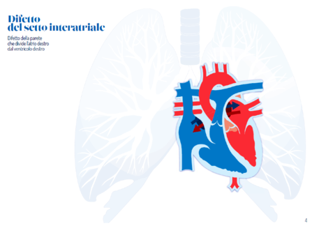 Sindrome di Down e cardiopatie congenite