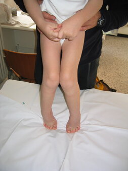Paralisi cerebrale infantile: la chirurgia ortopedica