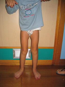 Paralisi cerebrale infantile: la chirurgia ortopedica