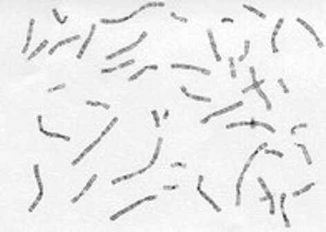 Malattie cromosomiche