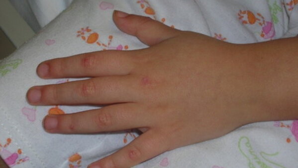 Dermatomiosite giovanile