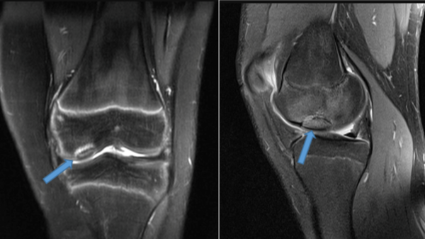Osteocondrite Dissecante