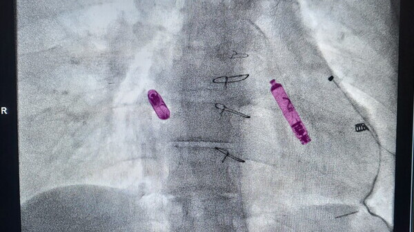 Cardiopatie congenite generatore wireless battere cuore