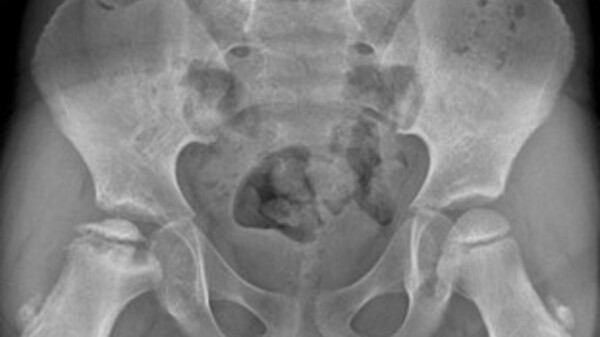 Malattia di Legg-Calvé-Perthes