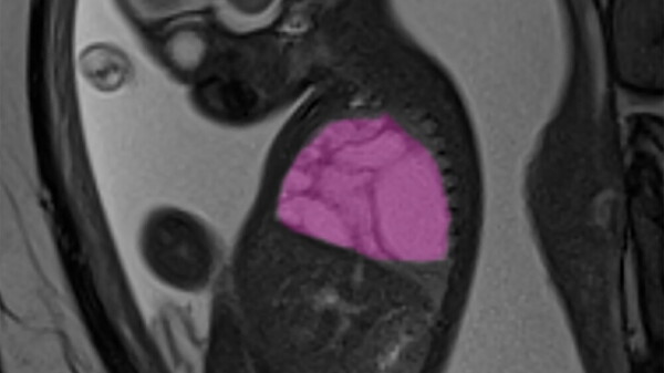 Operato utero cisti gigante polmone piccolo ora sta bene