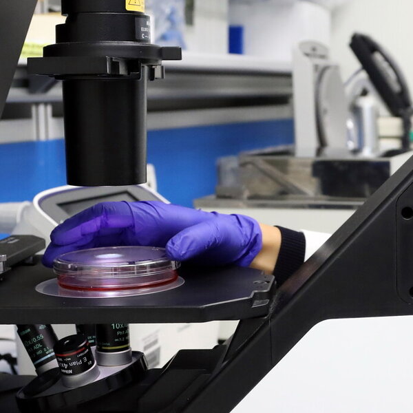 sangue molecola spia predice futuro rara malattia reumatologica bambini