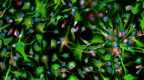 Tumori cerebrali sistema sperimentale 3D valutare possibili farmaci contro glioma