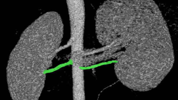 Ipertensione arteriosa anomalie renali danno cuore bambini