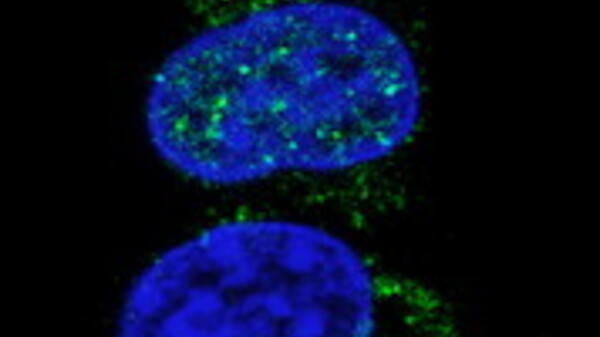 Cellule Natural Killer modificate geneticamente superare difese tumori