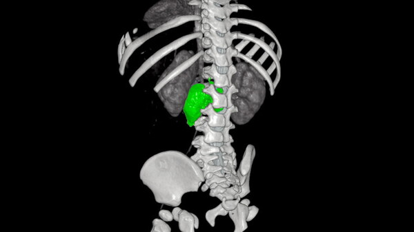 Nuova strategia chirurgica integrata per rimuovere un complesso neuroblastoma